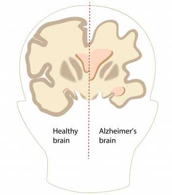 dementia-geriatric-neurology
