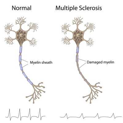 multiple-sclerosis-ms