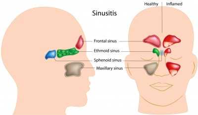 sinus headaches
